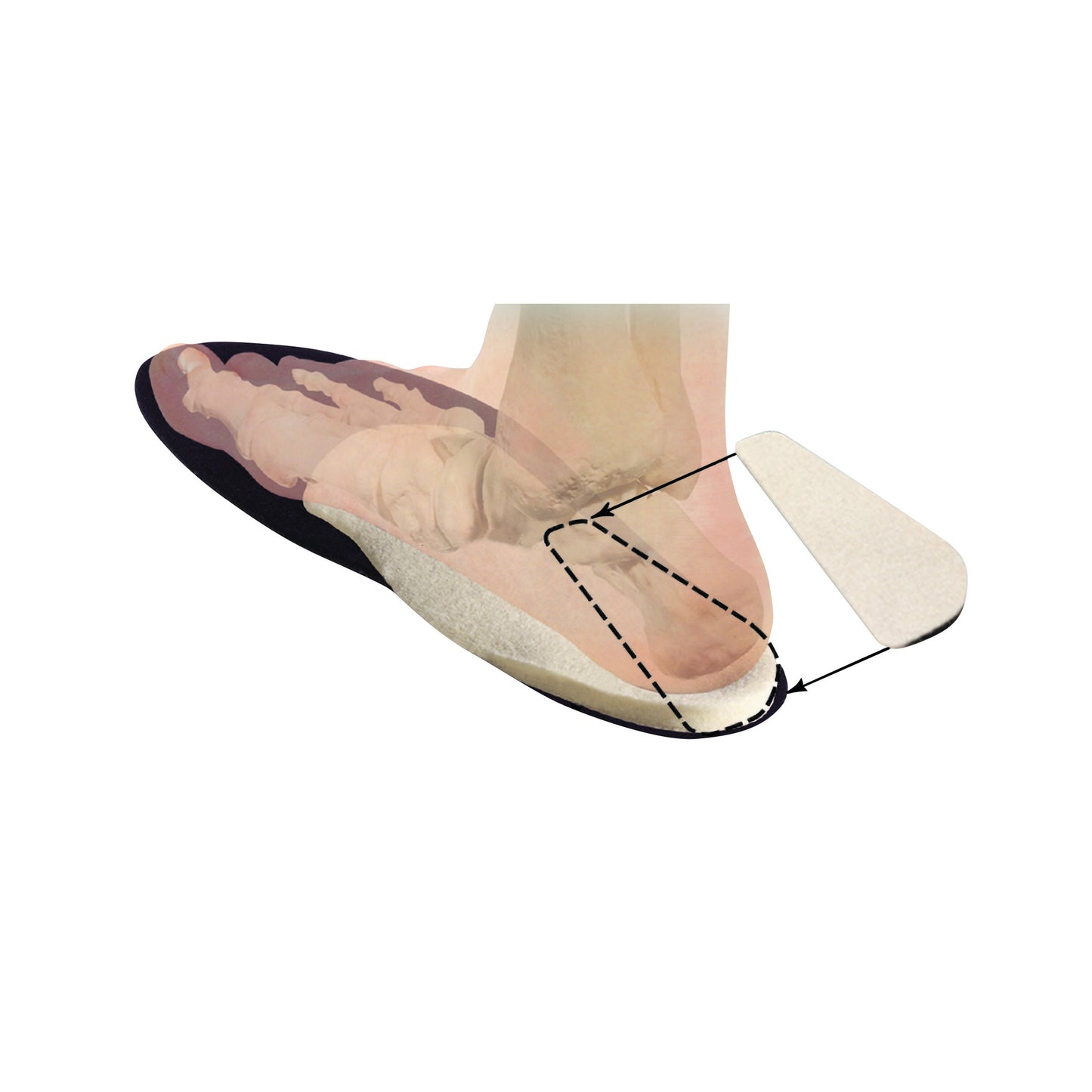 Posting Heel Wedge, 5 Degrees, 1 Pair/Pack