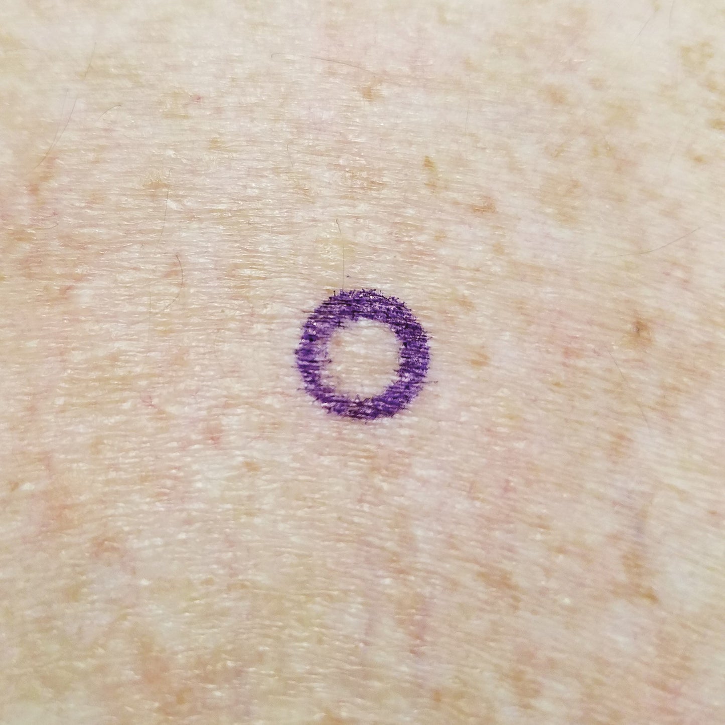 A purple circle on skin created with Viscot Accumark Radiopaque Injection Site Markers, likely for medical or procedural use.