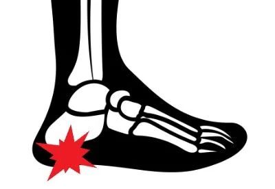 graphic of plantar fasciitis pain poitn