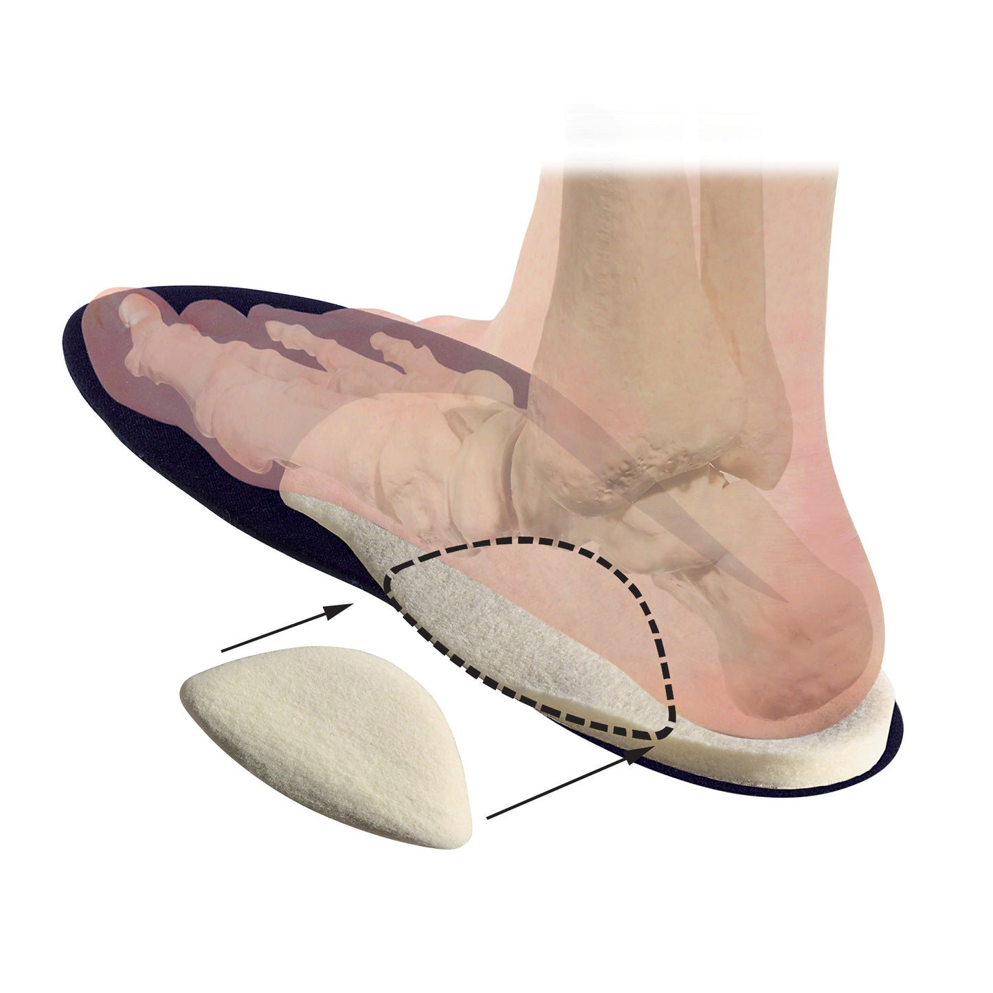 Hapad® Scaphoid Pad