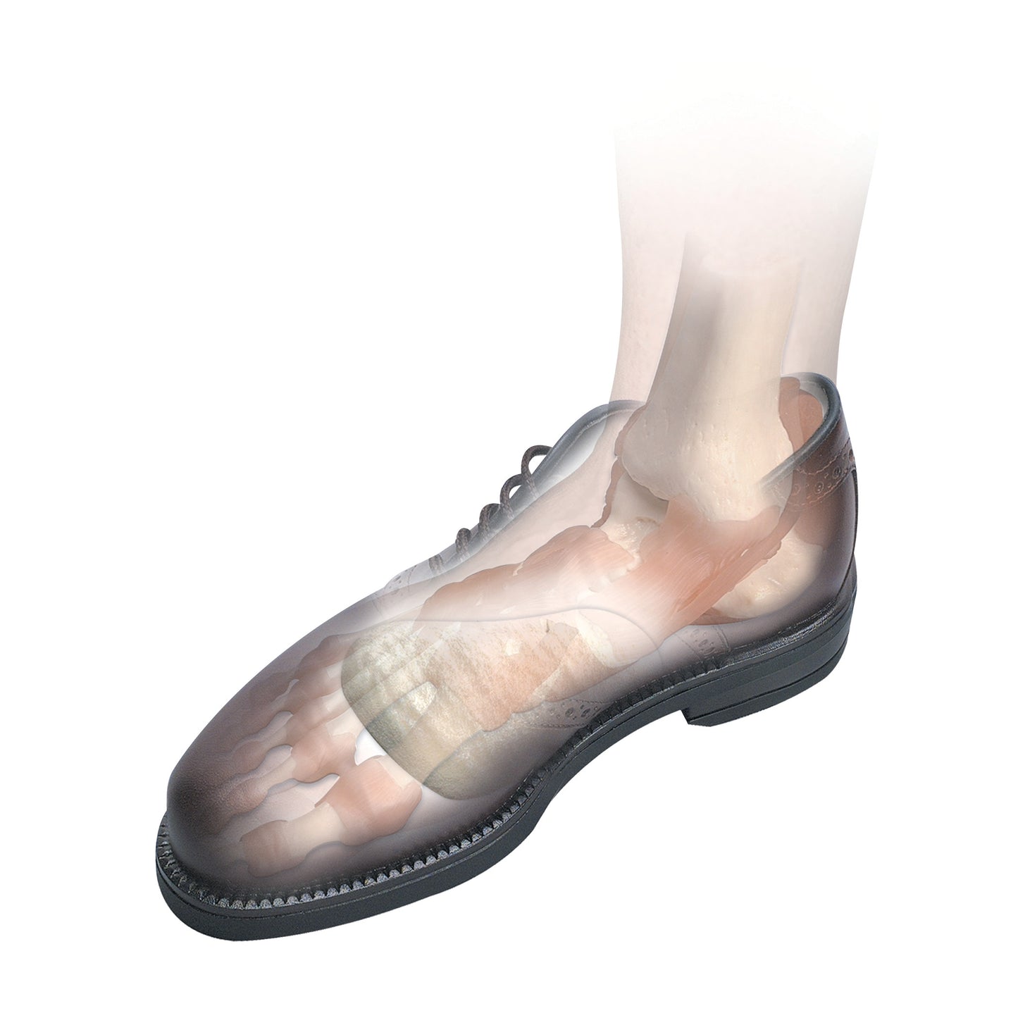 Longitudinal Metatarsal Arch Pads, 5/16"H, X-Small, 3 Pair/Pack