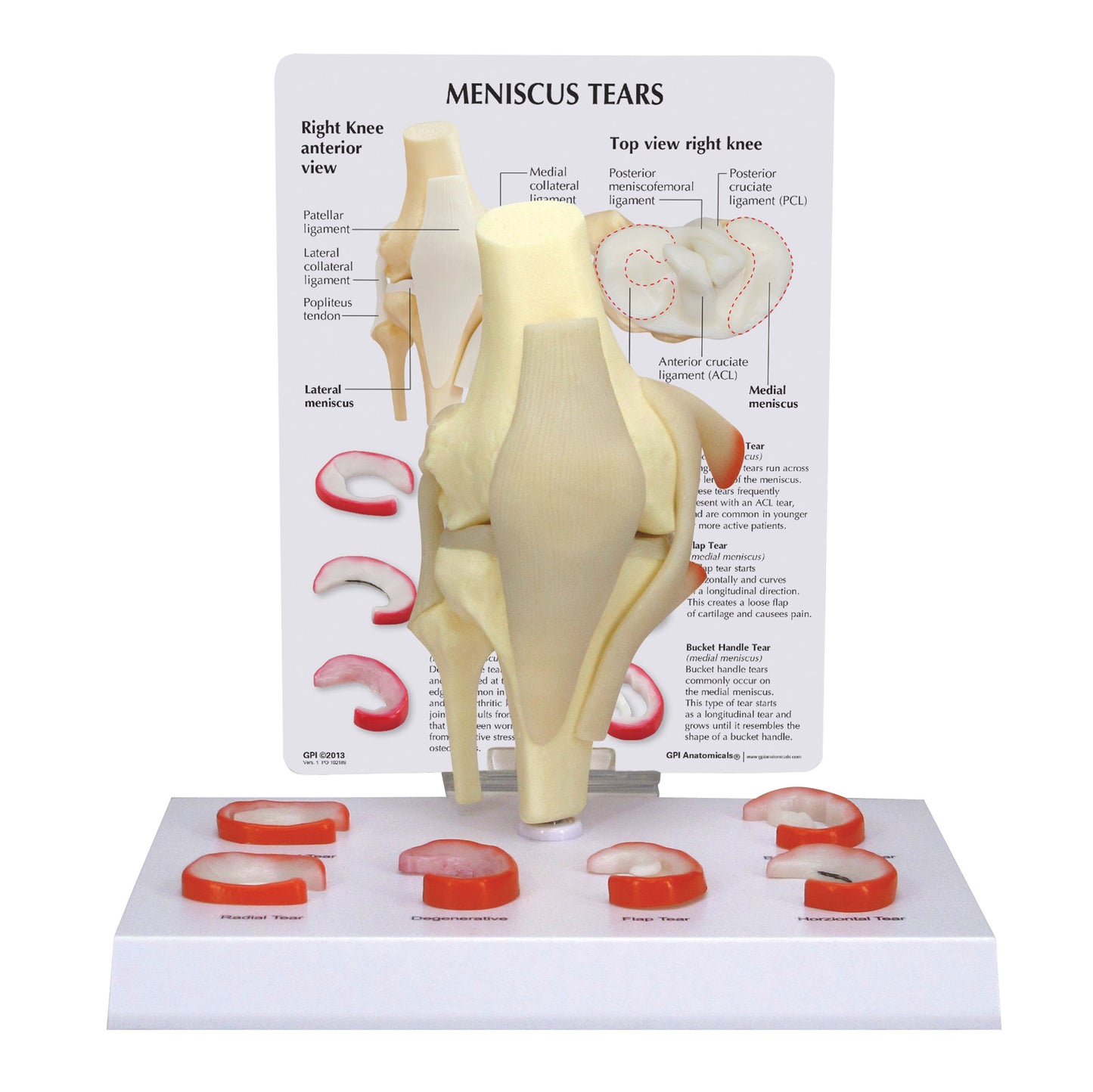 GPI Anatomicals® Meniscus 6 Tears Model
