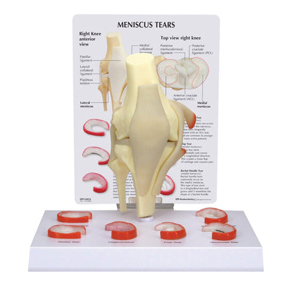 GPI Anatomicals® Meniscus 6 Tears Model