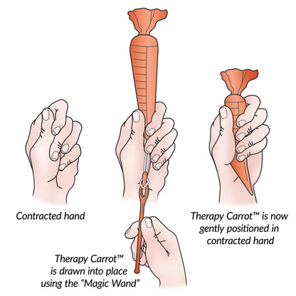 AliMed® Original Therapy Carrot™ Hand Contracture Orthosis Kit