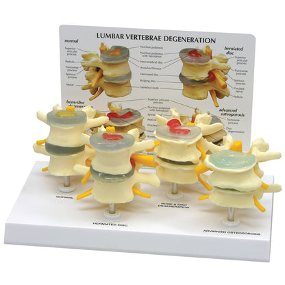 GPI Anatomicals® 4-Stage Vertebrae Model
