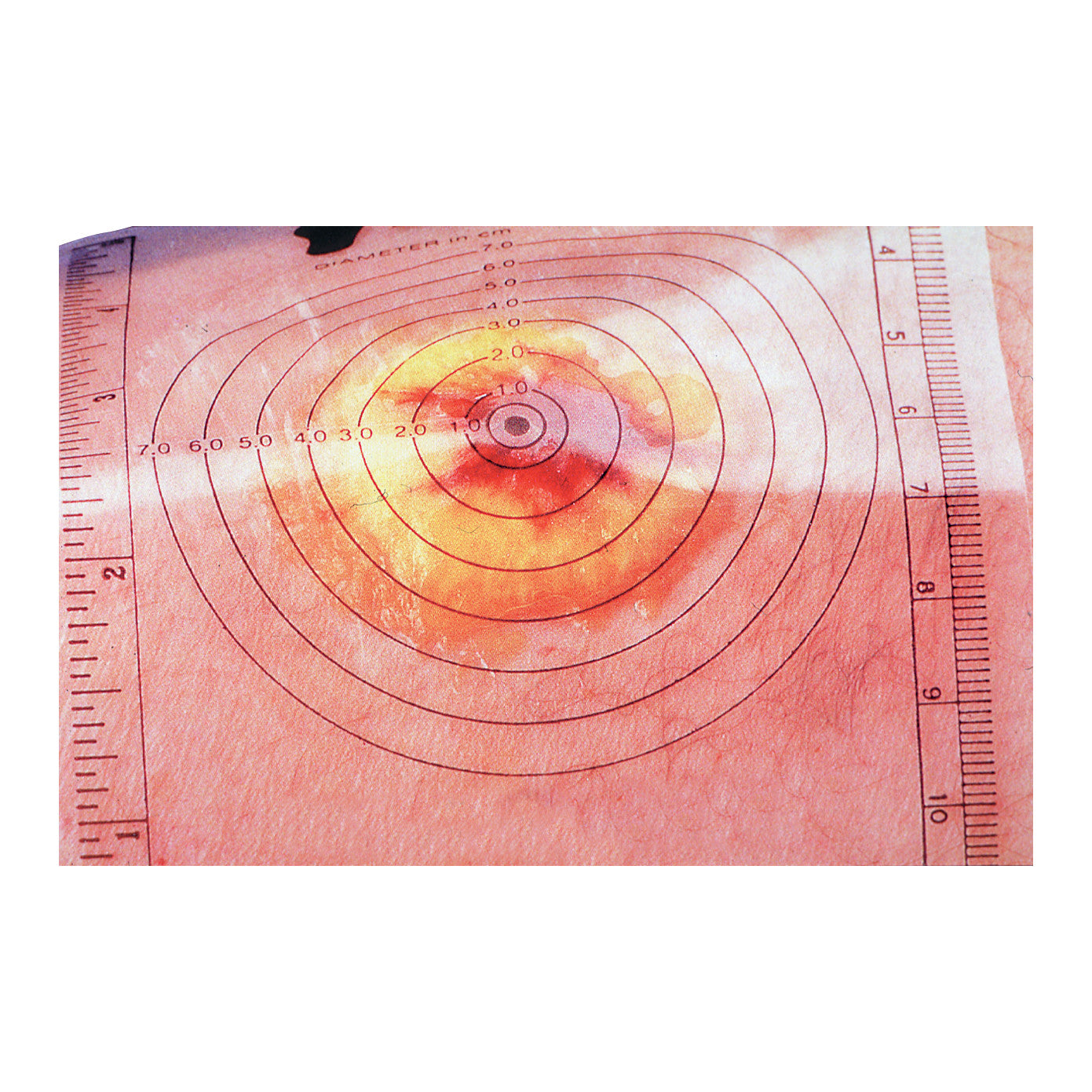 Disposable Wound Measuring Guide