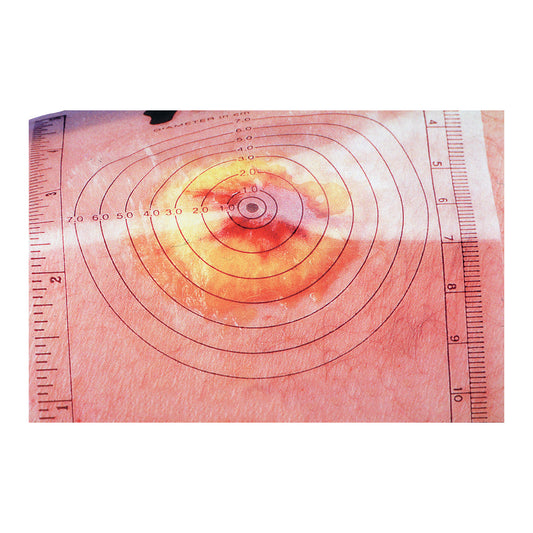 Disposable Wound Measuring Guide