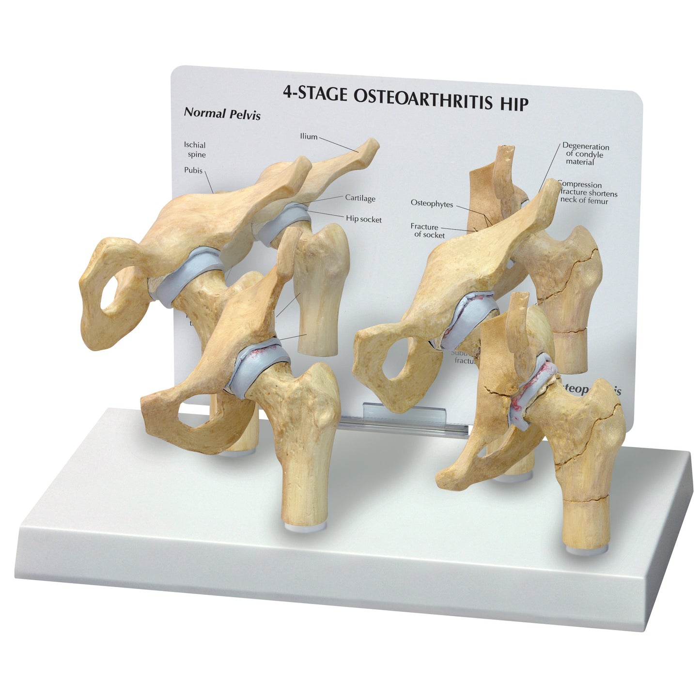 GPI Anatomicals® 4-Stage Arthritic Hip Model