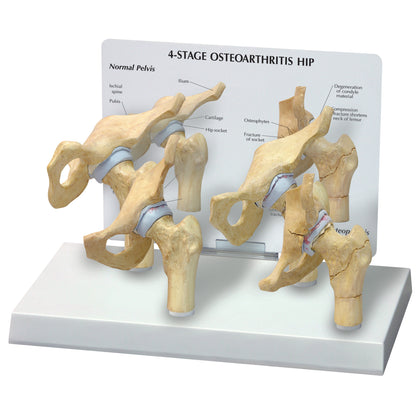 GPI Anatomicals® 4-Stage Arthritic Hip Model