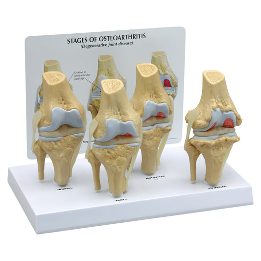 GPI Anatomicals® 4-Stage Osteoarthritis Knee Model