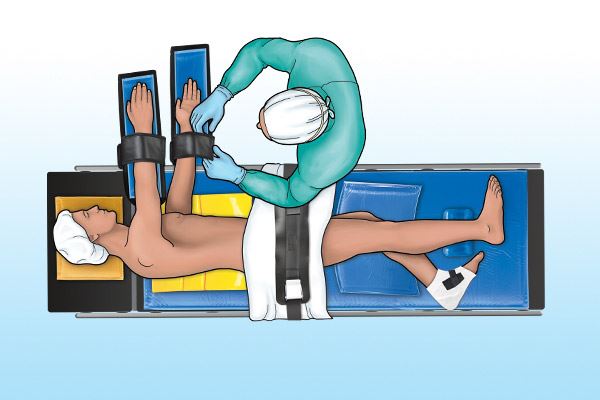 graphic of patient on operating table in lateral position 