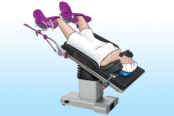 graphic of patient on operating table in Trendelenburg position 